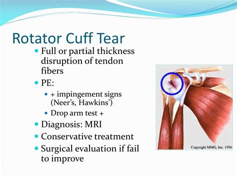 test for full tear of rotator cuff|diagnosis of rotator cuff tear.